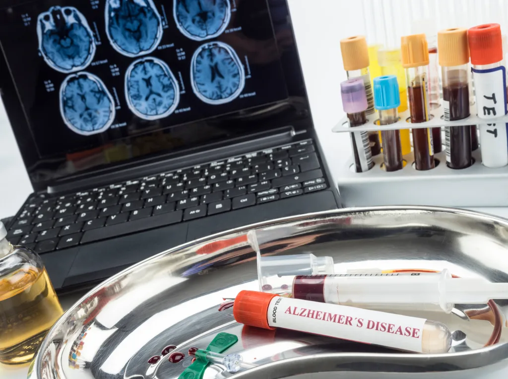 Ensayos clínicos para Alzheimer